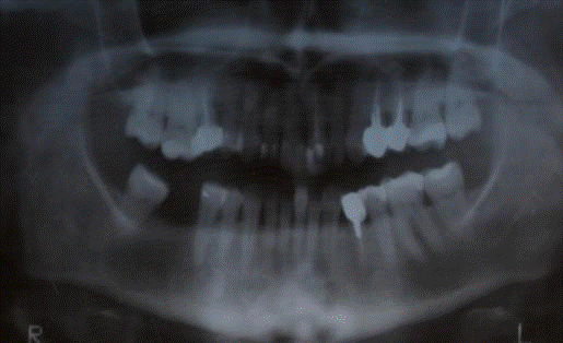Ортопантомограмма верхней и нижней челюсти пациентки А.