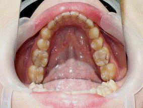 Прицельные рентгеновские снимки зубов 3.6. и 4.6 до ортопедического лечения.