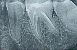 Рис. 30 - Прицельные рентгеновские снимки зубов 3.6. и 4.6 до ортопедического лечения.