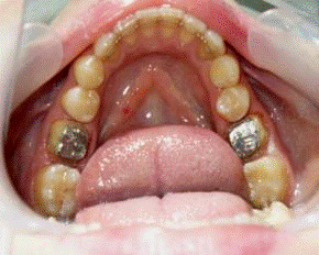 Результаты прочностного анализа системы «зуб-штифтовая культевая вкладка-литая коронка».
