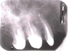 Прицельные рентгеновские снимки зубов пациента Л. контрольной группы. Отмечено отличное краевое прилегание штифтовых культевых вкладок к тканям зуба.