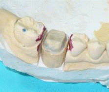 Металлокерамические коронки зафиксированы в полости рта.