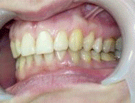 Рис. 39 - Металлокерамические коронки зафиксированы в полости рта.