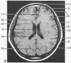 Лучевая анатомия супратенториальных отделов головного мозга.