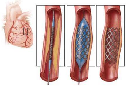 Установка стента в коронарную артерию.