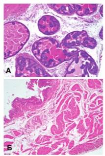 Гистологическая картина предстательной железы (А) (Ув. 200х) и мочевого пузыря (Б) (Ув. 100х) крыс с МС. Окраска гематоксилином и эозином.