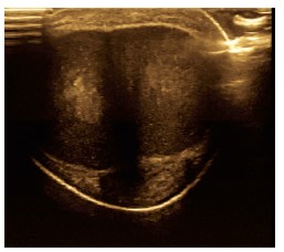 Ультразвуковая картина поперечного среза висячей части полового члена с признаками фиброза в правом пещеристом теле.