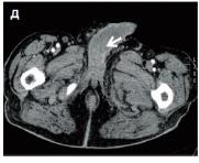 Рис. 4. КТ-картина метастатического поражения: а - легких; б - печени и селезенки; в - левой почки; г - брюшины; д - полового члена.