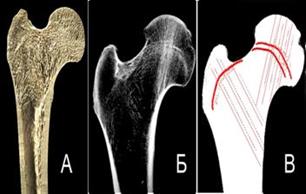 А - фронтальный срез верхней части бедренной кости. Б - рентгеновский снимок верхней трети бедренной кости (видны силовые линии). В - скиаграмма бедренной кости. Распределение силовых линий Рисунок 9 - Трабекулярная и кортикальная структуры кости.