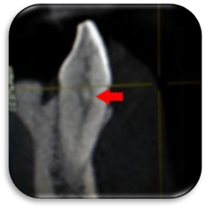 Саггитальный срез 33 зуба. 2 канала сливаются в один в средней трети корня.