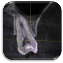 Трансверзальный срез 25 зуба. 3 тип строения (2-1-2). 2 канала имеют общее устье и разветвляются непосредственно в устьевой части.