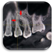 Саггитальный срез 24 и 25 зуба. 24 зуб - изгиб в трансверзальной плоскости (небно в средней трети корня), 25 зуб - значительный изгиб корня медиально.