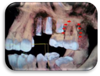 D-реконструкция челюстей. Дистальный изгиб медиально-щечного корня и двойной изгиб дистально-щечного корня 17 зуба.