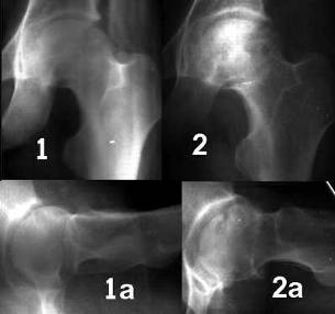 Рентгенограммы б-го П., 25 лет через 3 (1) и 8 (2) месяцев от начала заболевания. 2-3 и 4 стадия АНГБК. Обзорные рентгенограммы (1 и 2) и рентгенограммы по Лаунштейну (1а и 2 а).