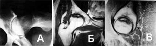 Больной Д., 35 лет. АНГБК 1-2 стадия. А - рентгенограмма по Лаунштейну, Б - МРТ фронтальная плоскость, В - МРТ горизонтальная плоскость.