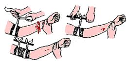 Остановка артериального кровотечения закруткой а - завязывание узла; б - закручивание палочкой; в - закрепление палочкой.