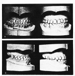 Диагностические модели челюстей больной Д. в фас (а) и в профиль (б). Слева — до лечения.