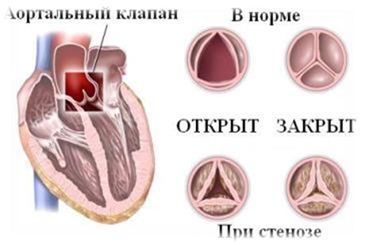 Пороки сердца. Анализ течения беременности и родов у женщин с пороками сердца.