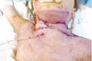 Пациентка К. Интраоперационное фото после устранения контрактуры, транспозиции лоскута и наложения швов.