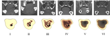 Шесть типов архитектоники костной ткани челюстей при полной адентии, верифицированных по изображениям, полученным с помощью компьютерной томографии.