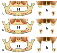 Схема трёх фенотипов анатомо-топографического состояния челюстных костей у пациентов с полным отсутствием зубов.