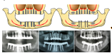 Схема и рентгенограммы демонстрирующие расположение имплантатов при различной толщине и типе архитектоники альвеолярных отростков у пациентов группы А.