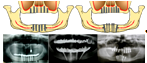 Схема и рентгенограммы демонстрирующие расположение имплантатов при различной толщине и типе архитектоники альвеолярных отростков у пациентов группы Б.