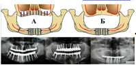Схема и рентгенограммы демонстрирующие расположение имплантатов при различной толщине и типе архитектоники альвеолярных отростков у пациентов группы В.