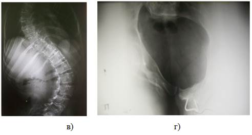 Рис. 1. Фото беременной Ч., 32 лет, сзади (а), спереди (б), рентгенограмма ее позвоночника в прямой проекции (в), рентгенограмма ее таза (г). Левосторонний грудной сколиоз IV степени тяжести с компенсаторной поясничной дугой.